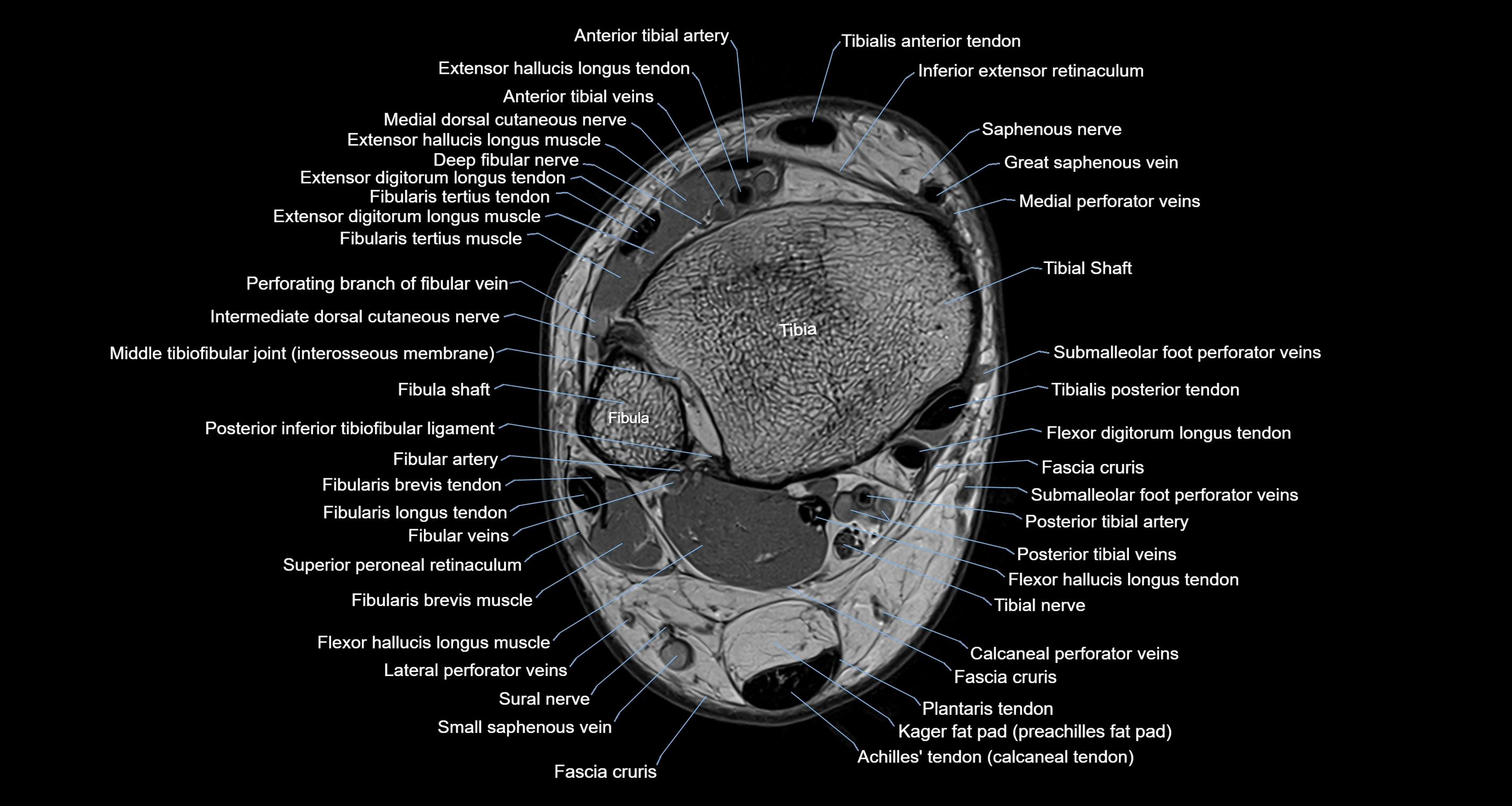 Ankle axial anatomy 3T MRI images -img-10001-00009.webp
